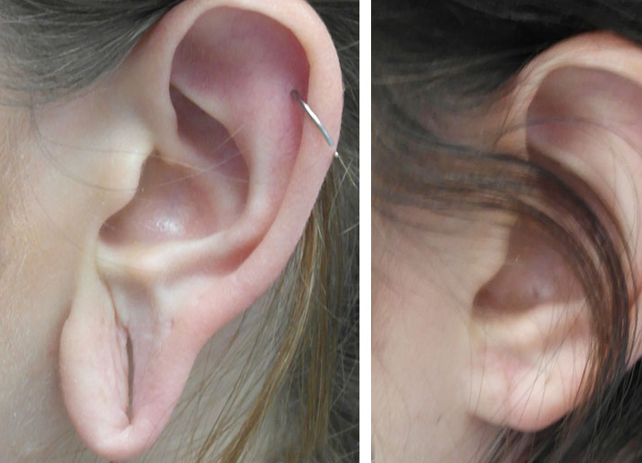 Ear Lobe Repair Surgery in Mumbai