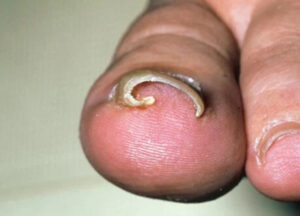 Ingrown Toe Nail Surgery in Mumbai `