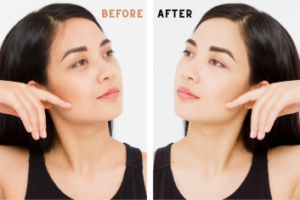 Expert Tips for Choosing the Right Provider for Face & Neck Lift HIFU Skin Care Treatment (1)