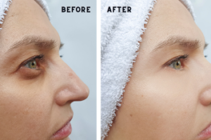 Say Goodbye to Dark Circles Premier Laser Treatment in Mumbai