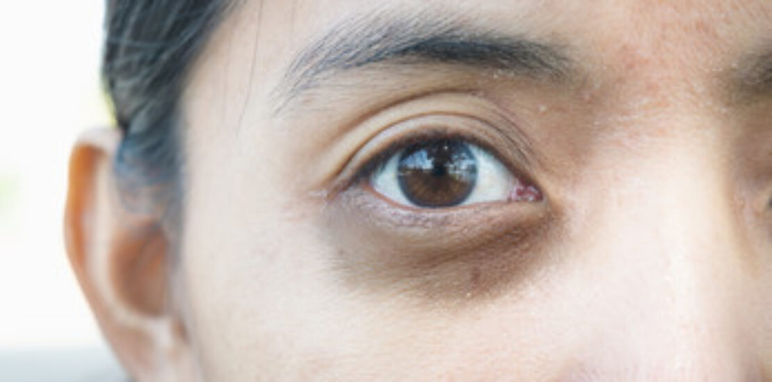 5 Causes Of Dark Circles Under The Eyes