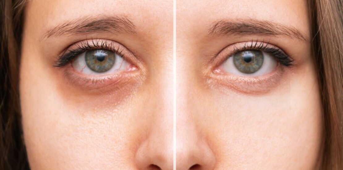 Laser Treatment in Mumbai